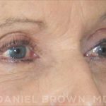 Blepharoplasty Before & After Patient #8787