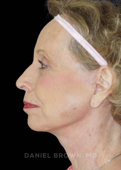 Blepharoplasty Before & After Patient #8787
