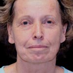Blepharoplasty Before & After Patient #8787