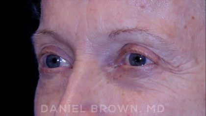 Blepharoplasty Before & After Patient #8787