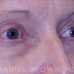 Blepharoplasty Before & After Patient #8787