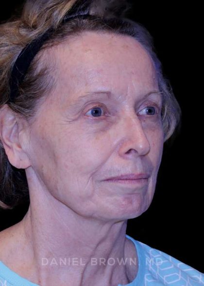 Blepharoplasty Before & After Patient #8787