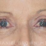 Blepharoplasty Before & After Patient #8787