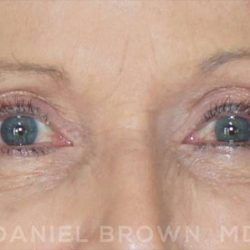 Blepharoplasty Before & After Patient #8787