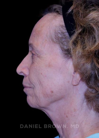 Blepharoplasty Before & After Patient #8787