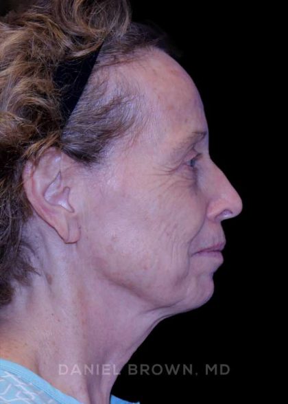Blepharoplasty Before & After Patient #8787
