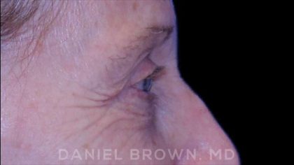 Blepharoplasty Before & After Patient #8787