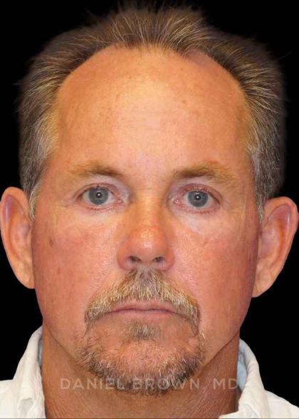 Blepharoplasty Before & After Patient #8808