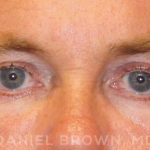 Blepharoplasty Before & After Patient #8808