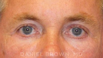 Blepharoplasty Before & After Patient #8808
