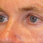Blepharoplasty Before & After Patient #8808