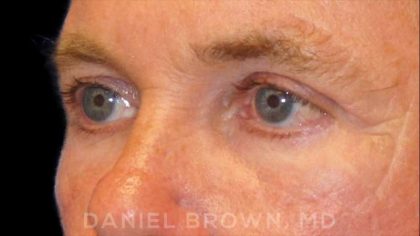 Blepharoplasty Before & After Patient #8808