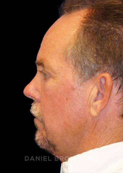 Blepharoplasty Before & After Patient #8808