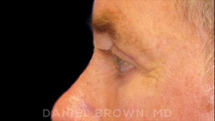 Blepharoplasty Before & After Patient #8808