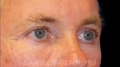 Blepharoplasty Before & After Patient #8808