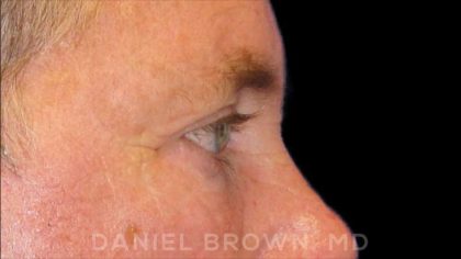 Blepharoplasty Before & After Patient #8808