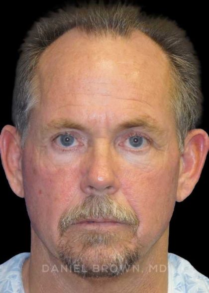 Blepharoplasty Before & After Patient #8808