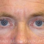 Blepharoplasty Before & After Patient #8808