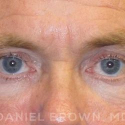 Blepharoplasty Before & After Patient #8808