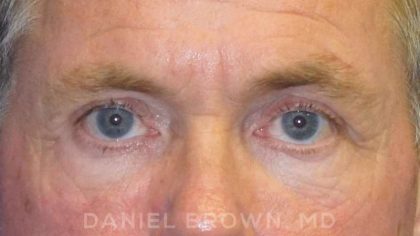 Blepharoplasty Before & After Patient #8808