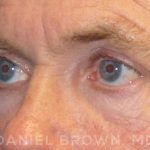 Blepharoplasty Before & After Patient #8808