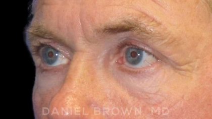 Blepharoplasty Before & After Patient #8808