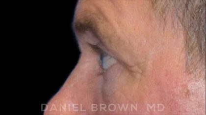Blepharoplasty Before & After Patient #8808