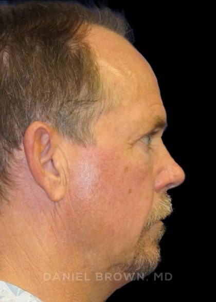 Blepharoplasty Before & After Patient #8808