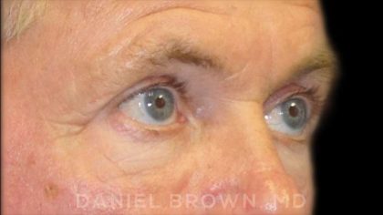 Blepharoplasty Before & After Patient #8808