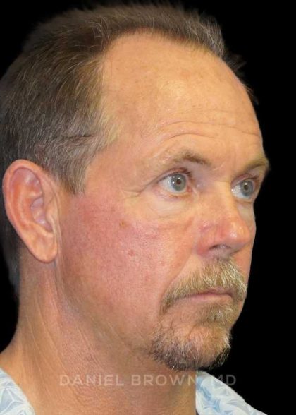 Blepharoplasty Before & After Patient #8808