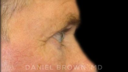 Blepharoplasty Before & After Patient #8808
