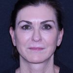 Facelift Before & After Patient #11562