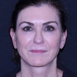 Facelift Before & After Patient #11562