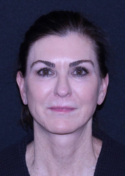 Facelift Before & After Patient #11562