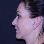 Facelift Before & After Patient #11562