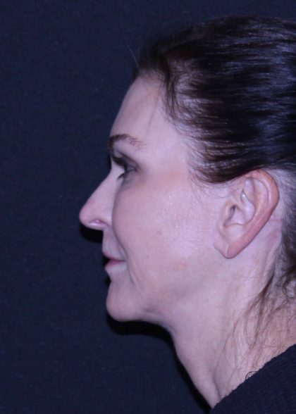 Facelift Before & After Patient #11562