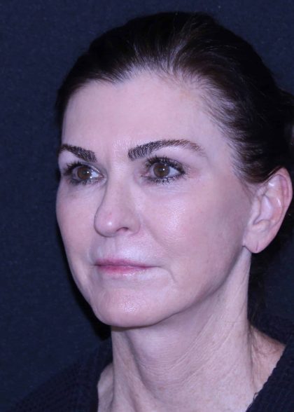 Facelift Before & After Patient #11562