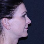 Facelift Before & After Patient #11562