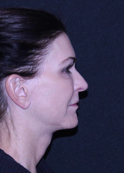 Facelift Before & After Patient #11562