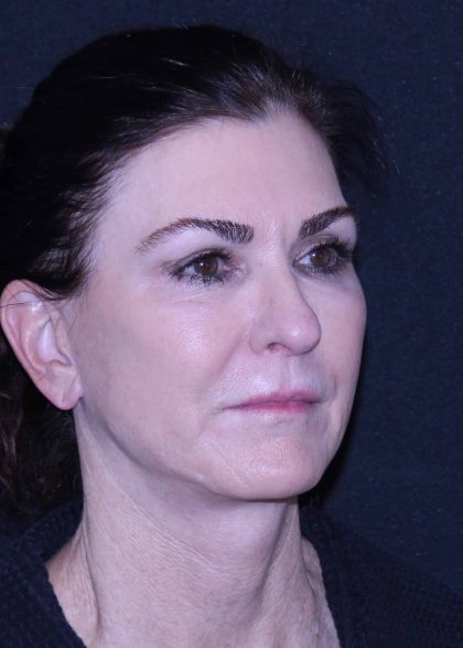 Facelift Before & After Patient #11562
