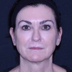 Facelift Before & After Patient #11562
