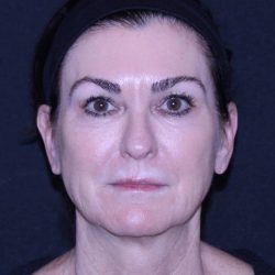Facelift Before & After Patient #11562