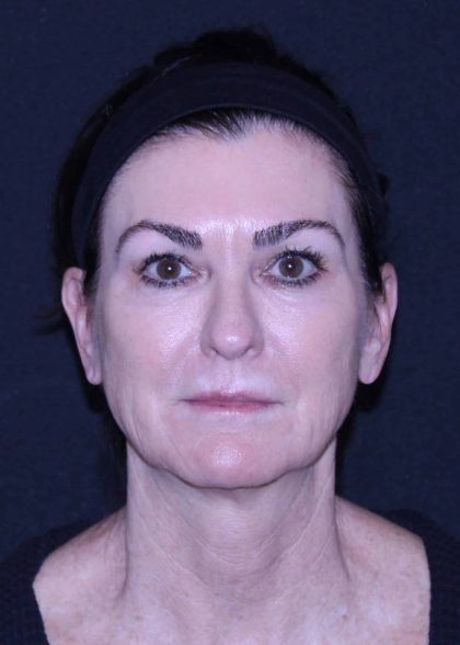 Facelift Before & After Patient #11562