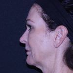 Facelift Before & After Patient #11562