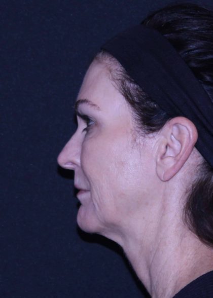 Facelift Before & After Patient #11562