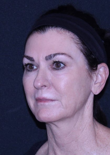 Facelift Before & After Patient #11562