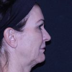 Facelift Before & After Patient #11562