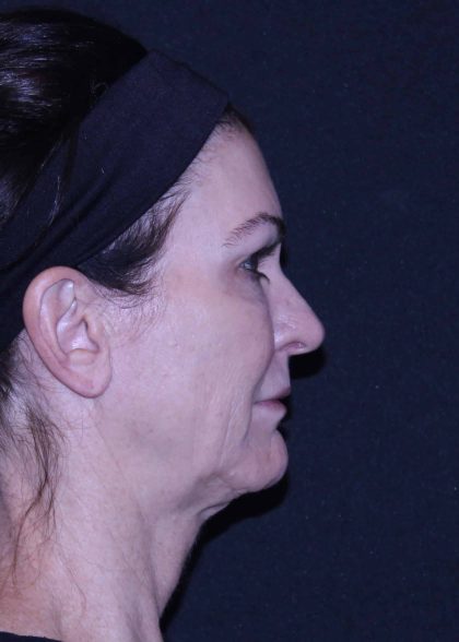 Facelift Before & After Patient #11562