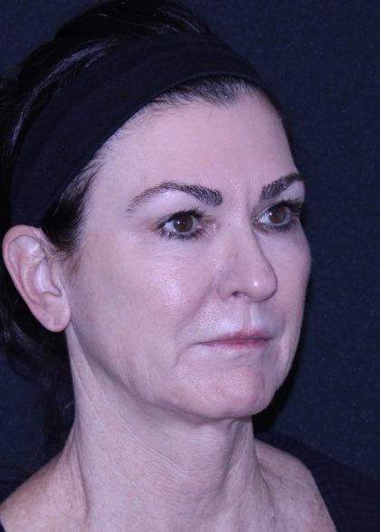 Facelift Before & After Patient #11562