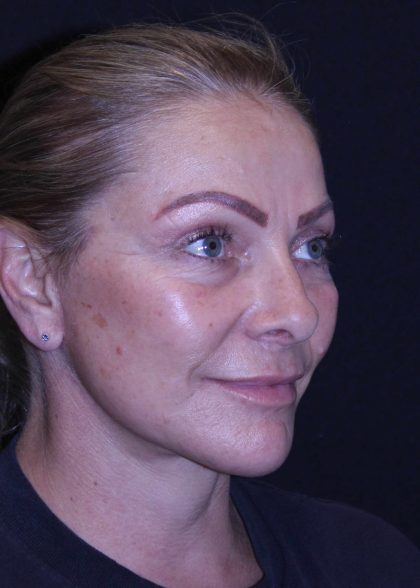Facelift Before & After Patient #11558